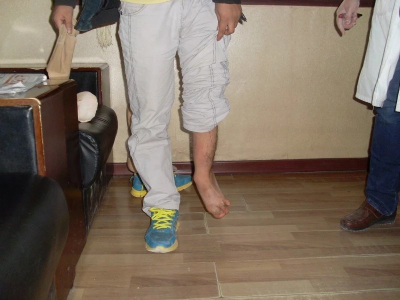 畸形腿、長短腿(圖1)